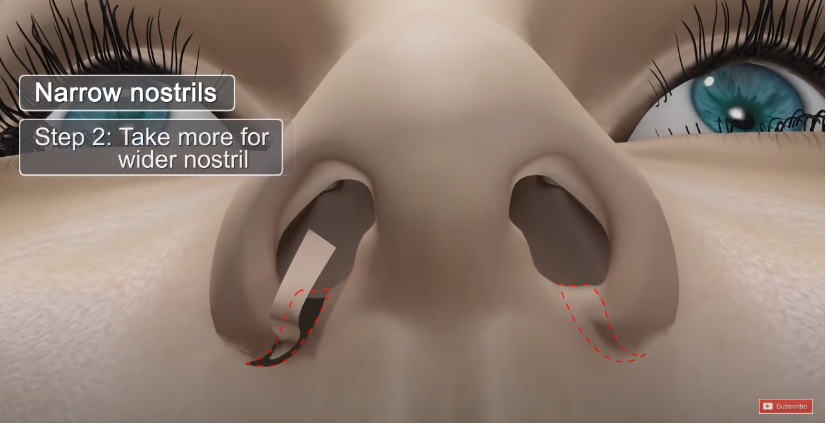 Is There a Nose Alar Reduction Surgery Without Scarring? (Looking at Before-and-After Photos) image 3