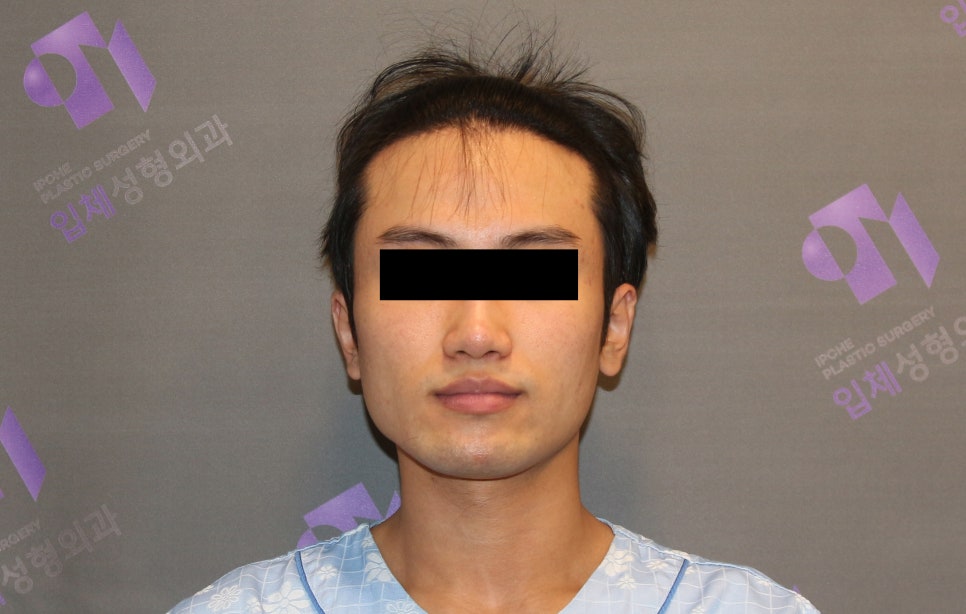 남자사각턱, 남자다운 턱선이 중요한 안면윤곽수술 관련 이미지 1