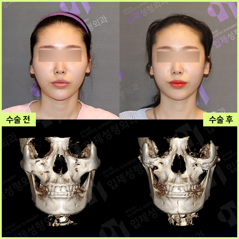 Why Consultation and Design Are Important Before Facial Contouring Surgery—Don’t Be Careless!! image 1