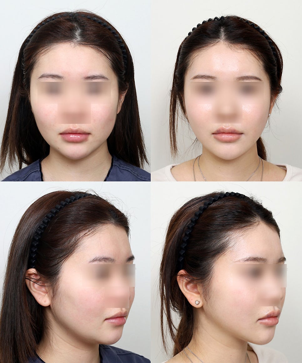 배우 하영, 나나 얼굴형 실제 윤곽수술은 어떻게 다를까? 관련 이미지 7