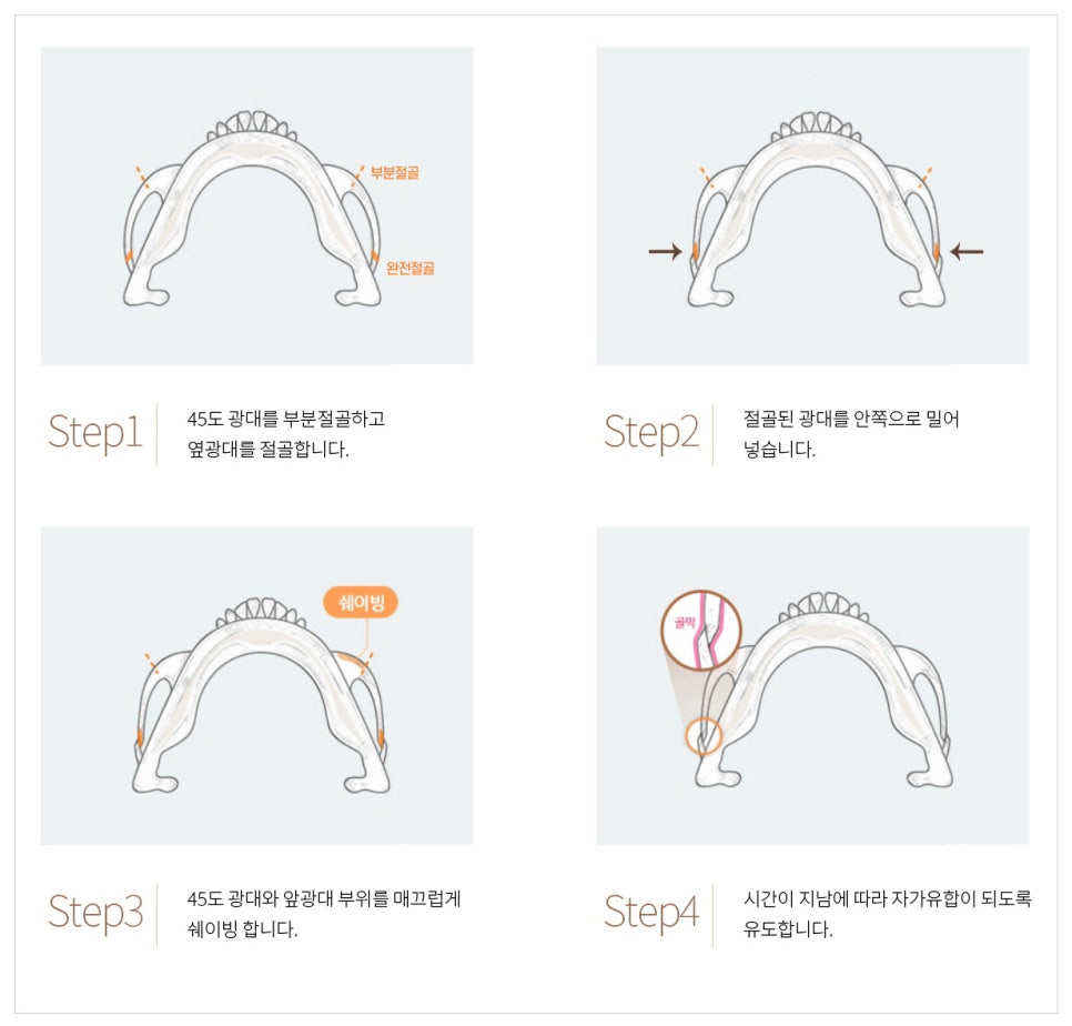 이런 분들은 230도입체광대축소술은 하지 마세요 관련 이미지 1