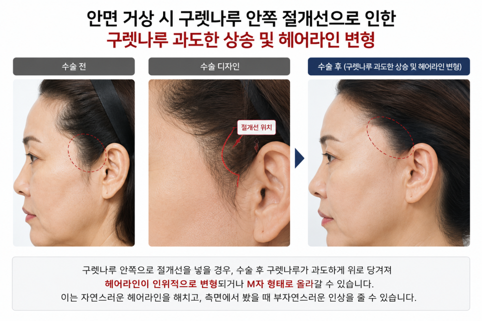 40대 안면거상 vs 60대 안면거상 관련 이미지 3