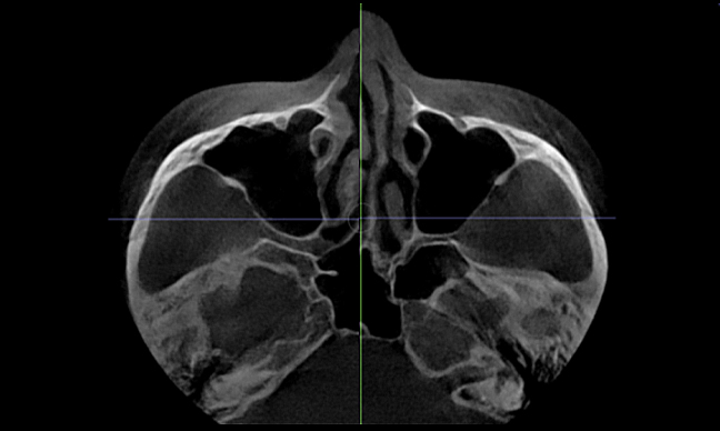 Will cheekbone reduction surgery also make the face smaller? : Learn about how to reduce prominent cheekbones with real surgical cases image 12