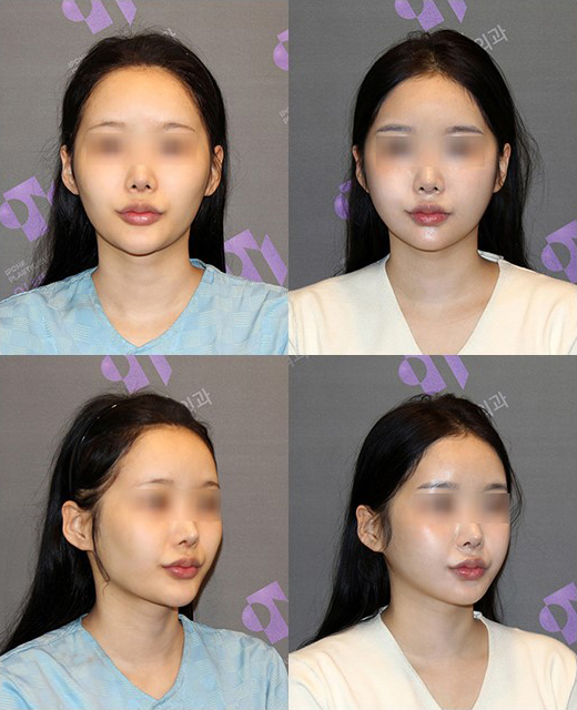 What Are the Features of a Youthful Face? Why Does a Small Chin Make a Face Look Younger? image 5