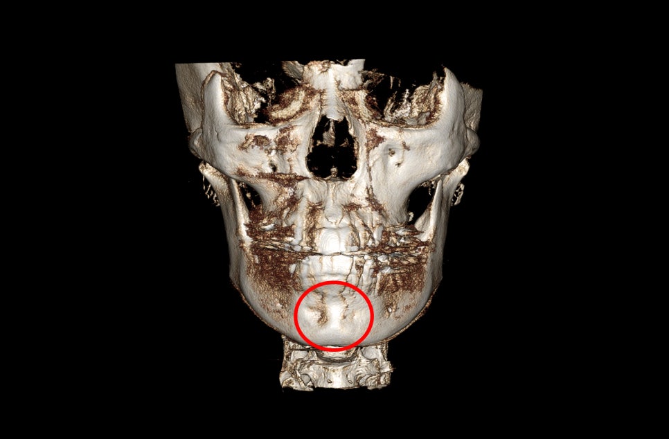 Does chin filler or an implant cause bone erosion? image 5