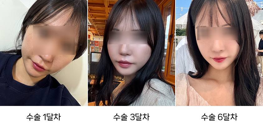 The Difference Between Swelling and Cheek Sagging After Facial Contouring Surgery image 4