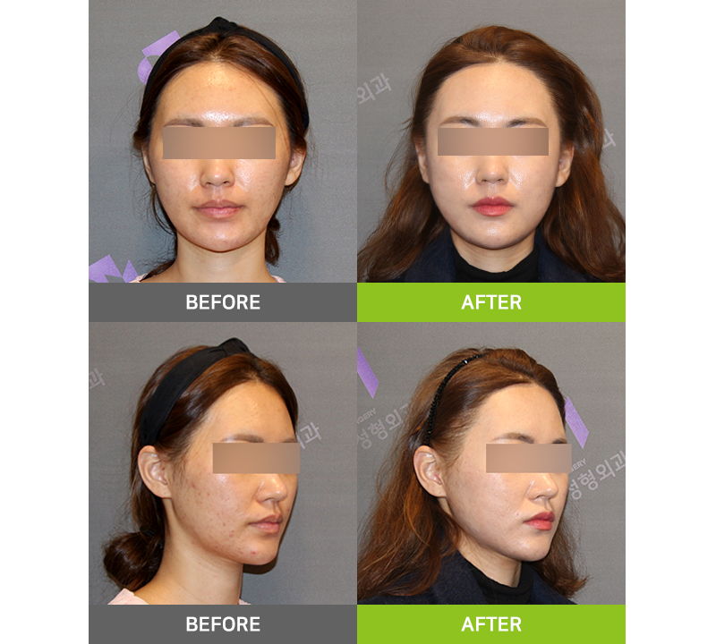I had cheekbone surgery, but the back cheekbone remains. Is there a way to fix it? image 6