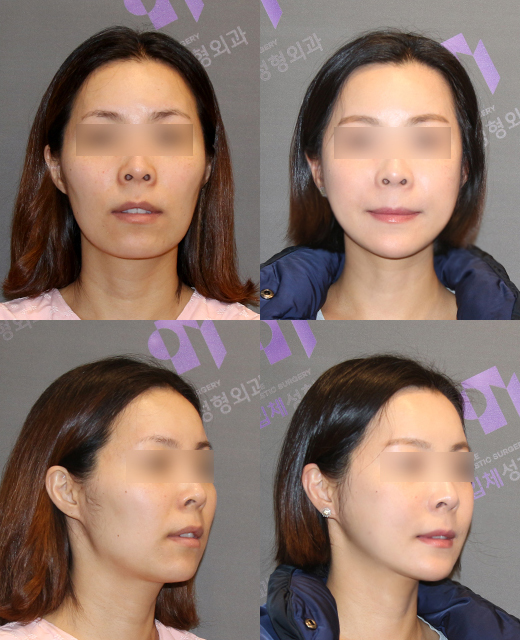 Side Effects of V-Line Square Jaw Surgery, Common Traits of People Who Experience Failed Results image 8