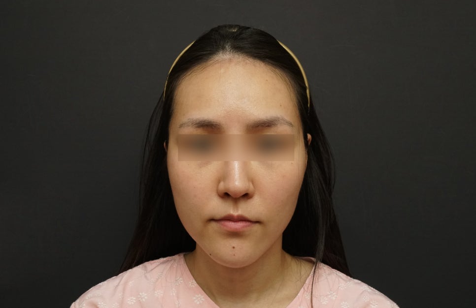 Long Chin, Long Face Contouring - Cases That Do Not Require Double Jaw Surgery image 3