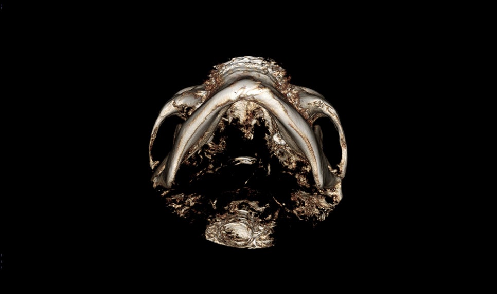 How Much Effect Does 230-Degree Three-Dimensional Zygomatic Reduction Have? image 9