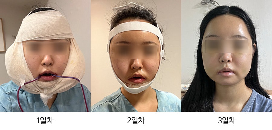 안면윤곽수술 후 붓기, 일차별(1일~30일차) 사진과 함께 회복기간 알아보기 관련 이미지 1