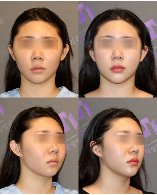광대수술 후 입벌리기 왜 조심해야 할까요? 관련 이미지 6