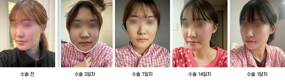 안면윤곽 수술 후 붓기, 일상생활은 언제부터 가능한가요? 케이스별로 알아보기 관련 이미지 11