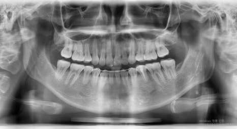 Which Surgery Do I Need: Contouring Surgery or Double-Jaw Surgery? image 21