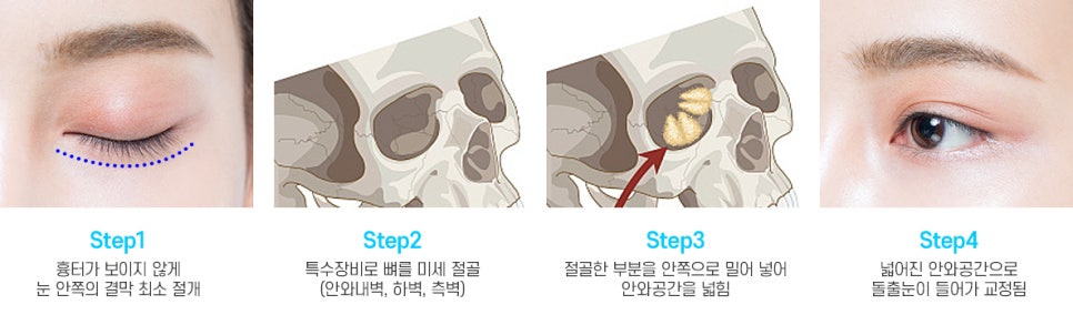 돌출눈과 함몰눈은 어떤 수술로 교정이 가능한가요? 관련 이미지 8