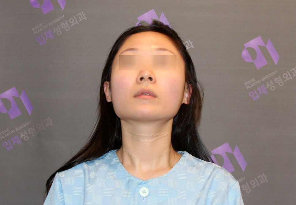 안면윤곽 볼처짐 원인은 무엇인가요? (솔직한 생각) 관련 이미지 2