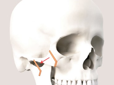 Why Is Male Cheekbone Reduction Different from Female Cheekbone Reduction? image 5