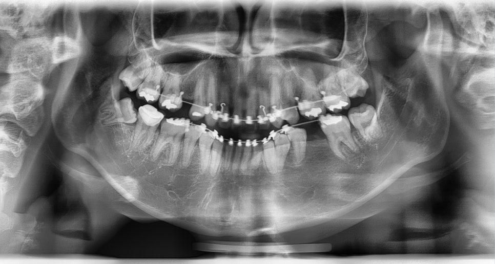 Long Chin, Long Face Contouring - Cases That Do Not Require Double Jaw Surgery image 13
