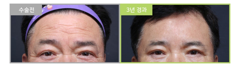처진 눈과 눈매교정이 눈수술이 아닌 이마눈썹거상술을 해야한다고? 관련 이미지 2