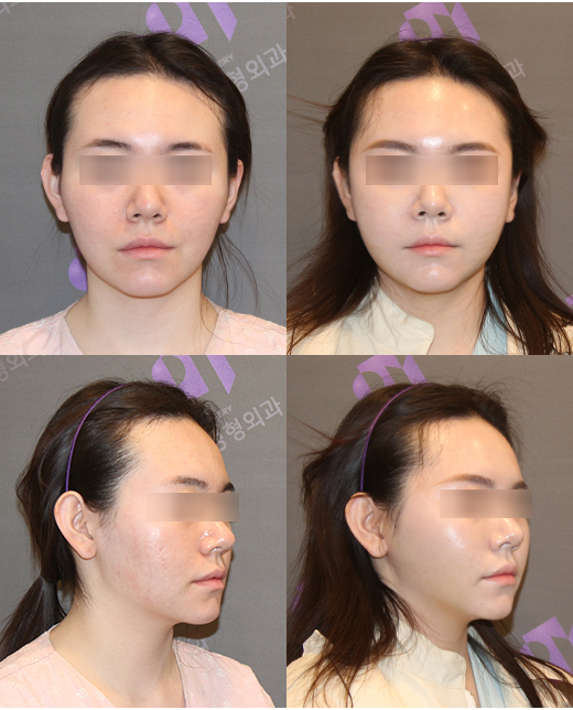 What Procedures Are Good to Have After Facial Contouring Surgery? image 3