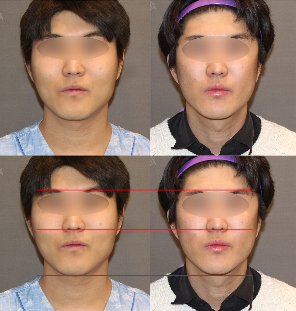Male Cheekbone Reduction Surgery: Looking at Real Cases of Facial Contouring Surgery image 5