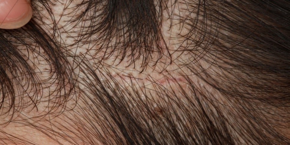 광대수술 후 나타날 수 있는 불편한 증상들은 어떤 것이 있을까요? 관련 이미지 6