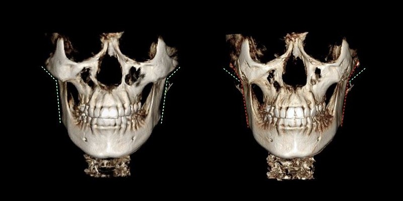 Cheekbone Reduction Surgery: A 2–3 mm Difference in the Side Cheekbones Makes a Big Change in the Face. image 4