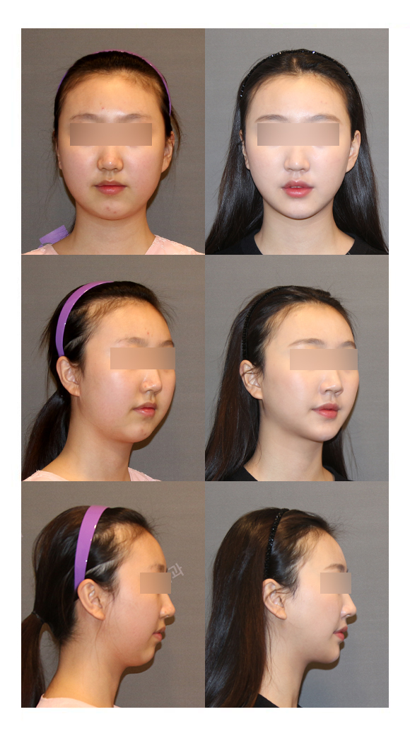 [Chin Correction Surgery] Implants and Genioplasty: Real Patient Cases and How They Work image 6