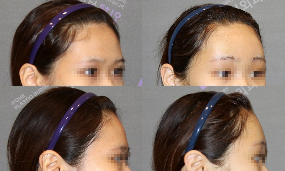 눈썹뼈돌출, 무조건 깎는 것이 답일까요? 눈썹뼈절삭부터 이마성형까지 관련 이미지 10