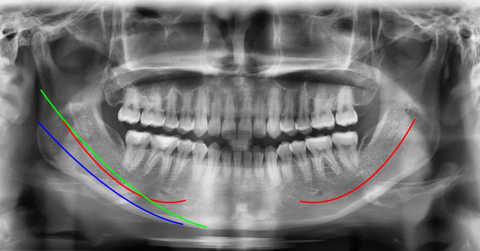 What Side Effects Can Occur Due to Excessive Reduction in Facial Contouring Surgery? image 2