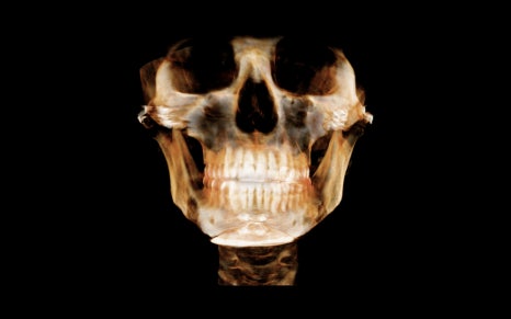Is Pin Removal Surgery Necessary After Facial Contouring? What About Swelling and Recovery Time? image 1