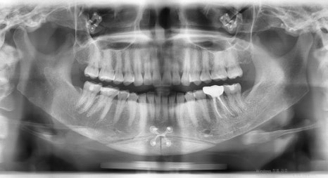 [Chin Surgery] Learning About Contouring Shaving and T-Osteotomy with Real Patient Cases (3) image 7