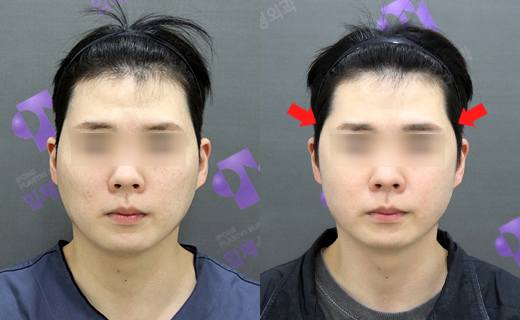 230도입체광대가 3D광대축소술보다 더 좋은가요? 관련 이미지 4