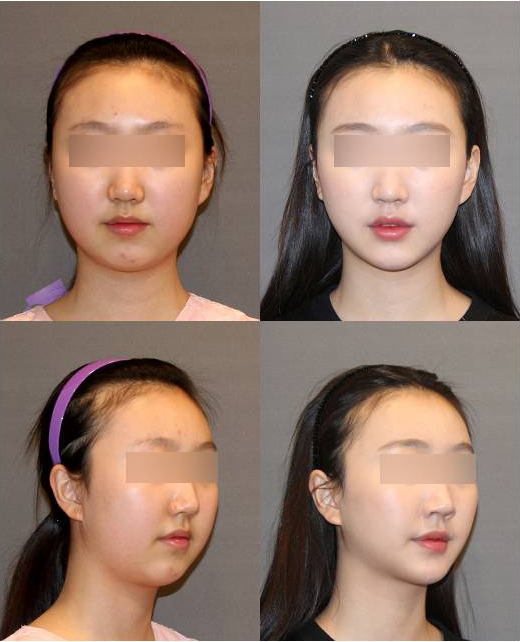 T절골 수술이라고 다 같은 수술이 아니예요! 관련 이미지 6