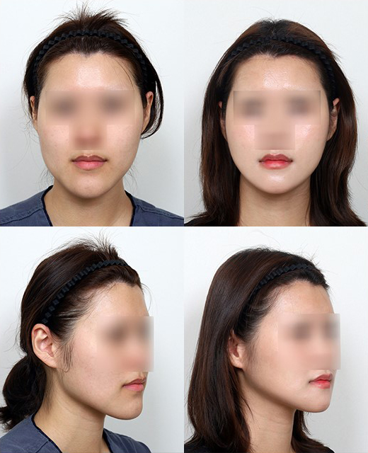 긴턱 교정은 어떤 수술이 좋을까요? 턱끝축소술의 한계와 실제 결과 관련 이미지 8