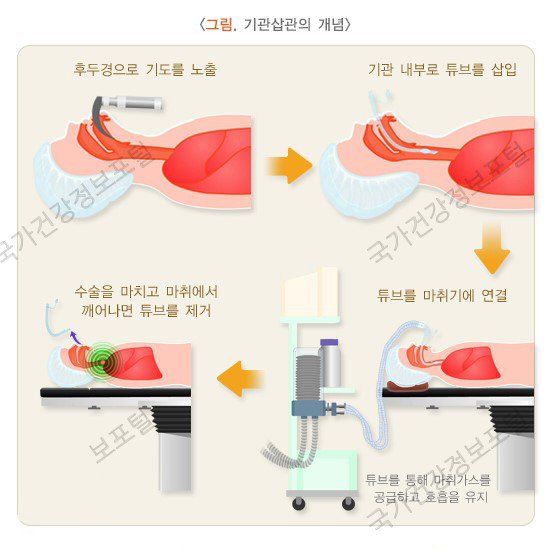 수면마취로 윤곽수술을 할 수 있나요? 관련 이미지 1