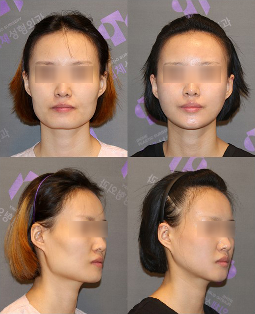 V-Line Square Jaw Surgery Is Good for the Front View Effect image 14