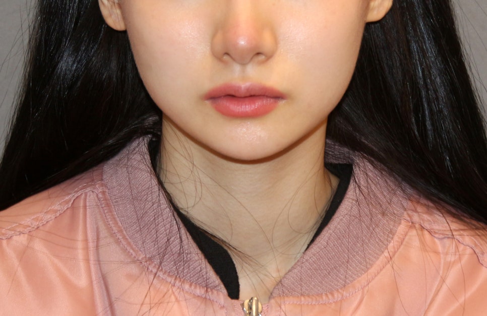 턱끝수술부작용, 이중턱이 생기는 이유는? - 전문의가 알려드립니다. 관련 이미지 2