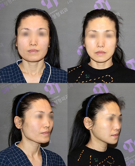 Are There People Who Can’t Have Cortical Ostectomy Surgery for a Frontal Square Jaw Effect? image 12