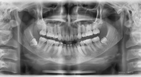 Which Surgery Do I Need: Contouring Surgery or Double-Jaw Surgery? image 15