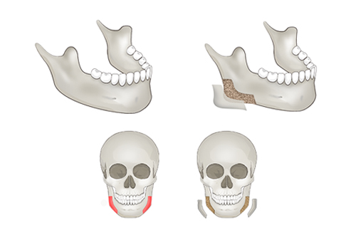Square Jaw Surgery: The Difference Between Cortical Osteotomy and Lateral Cortical Shaving image 1