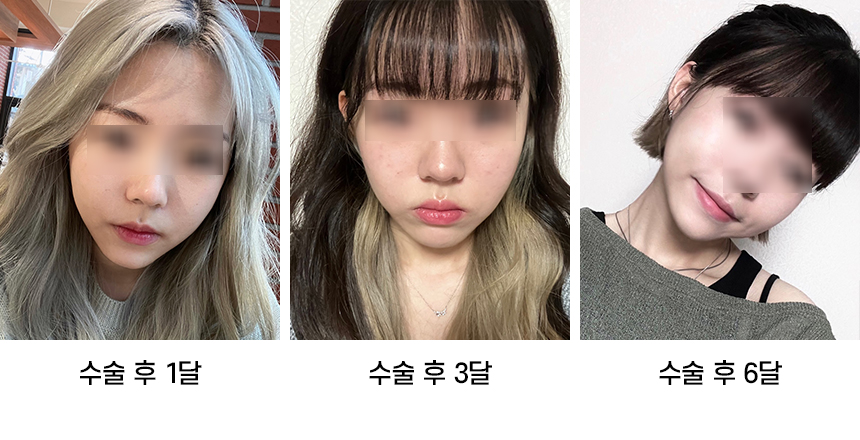 Do Not Confuse Facial Contouring Sagging with Swelling! image 6