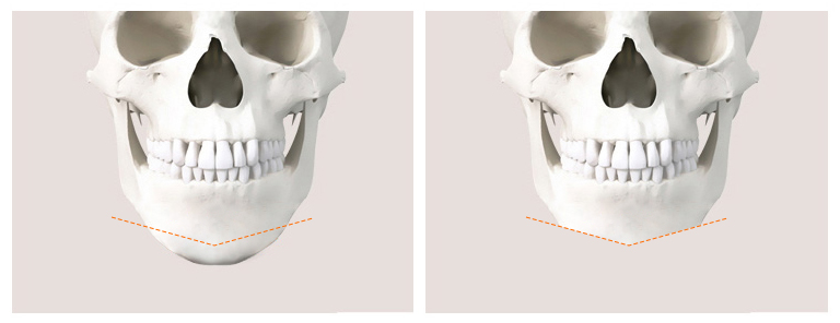 Is There a Way to Address the Secondary Angle That Appears After Chin Surgery? image 8