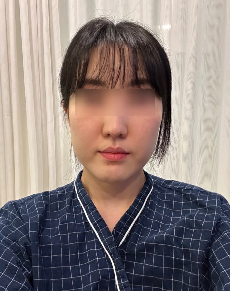 How Long Do Facial Contour Changes Continue After Facial Bone Contouring Surgery? (Day 1 to Day 365) — See With Photos image 1