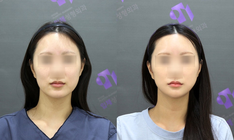 얼굴뼈 광대뼈 축소, 쉐이빙할 수 있는 부위와 효과는 어느정도 될까요? 관련 이미지 6