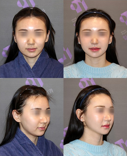 Which Surgery Do I Need: Contouring Surgery or Double-Jaw Surgery? image 13