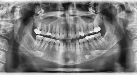 [Chin Surgery] Learning About Contouring Shaving and T-Osteotomy with Real Patient Cases (3) image 4