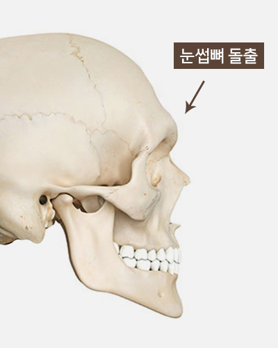 눈썹뼈돌출, 무조건 깎는 것이 답일까요? 눈썹뼈절삭부터 이마성형까지 관련 이미지 1