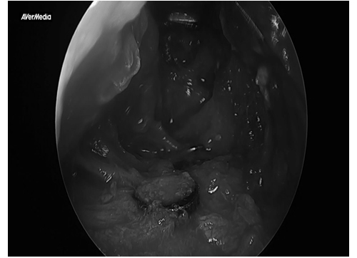 Considering revision cheekbone surgery, is it possible with a 230-degree three-dimensional cheekbone reduction as well? image 5