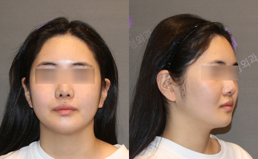 Will Jawline Surgery Make the Face’s Jawline More Defined? image 4